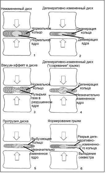 Схематическое изображение изменений, происходящих в межпозвонковом диске поясничного уровня и способствующих грыжеобразованию (Примечания к рисунку:<em> 1. Неизмененное фиброзное кольцо и пульпозное ядро диска. Вертикальные силы (стрелки) компенсируются эластическими свойствами кольца и ядра. 2. — Дегенеративно-измененный диск: отмечается пропорциональное снижение высоты кольца и ядра. Вертикальные силы все еще сбалансированы эластическими свойствами МПД. Возможно некоторое ограничение подвижности в межпозвонковом сегменте из-за «потери» высоты диска. 3. — Дегенеративно-измененный диск с вакуум-эффектом. Относительная сохранность кольца с более выраженным разрушением ядра. Вертикальная нагрузка компенсируется в основном сохранившимся фиброзным кольцом. Газообразование обусловлено инволютивными изменениями в пульпозном ядре. 4 — «Созревание» грыжи: более выраженное разрушение кольца, чем ядра. Основная масса пульпозного ядра, не сдерживаемая дегенеративно измененным фиброзным кольцом, испытывает избыточное давление по оси. Вертикальное давление на диск трансформируется в центробежные силы внутри ядра (маленькие стрелки), которые при недостаточной удерживающей способности фиброзного кольца могут привести к формированию грыжевого выпячивания. 5 — Протрузия диска: частичный разрыв с растяжением сохранившихся волокон фиброзного кольца, вследствие повышения давления в пульпозном ядре, способствует его миграции и выбуханию за пределы межпозвонкового промежутка. 6 — Сформировавшаяся грыжа диска: полный разрыв волокон фиброзного кольца является последним звеном в цепи дегенеративно-дистрофических процессов, развивающихся в МПД, и приводит к «выпадению» вещества пульпозного ядра в эпидуральное пространство, включая возможный разрыв задней продольной связки.</em>