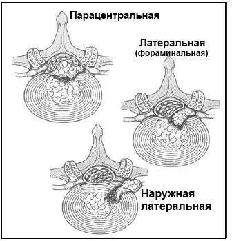 Типы грыж в зависимости от их взаимоотношения с межпозвонковым отверстием